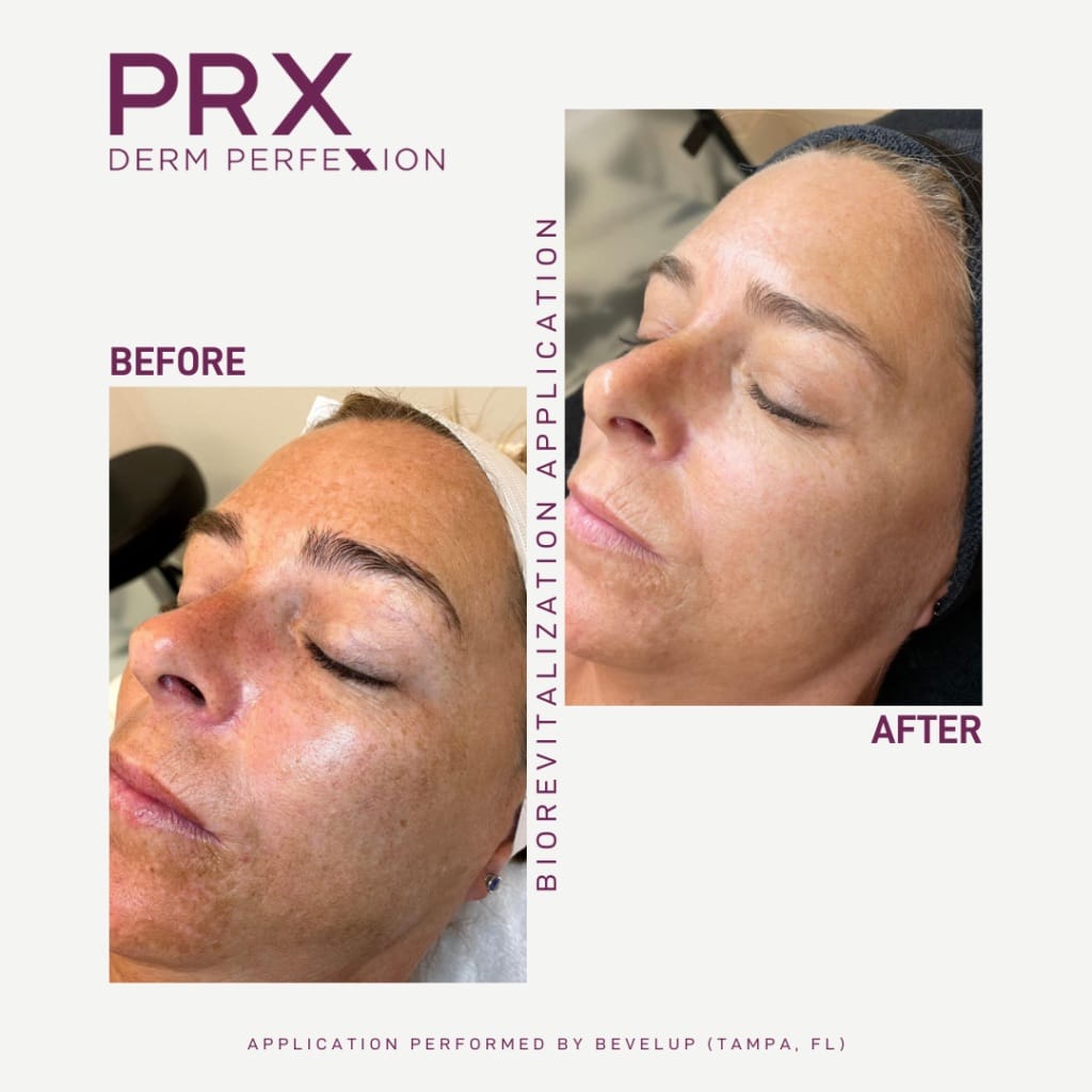 PRX Derm Perfexion Treatment Gallery The Beauty Spot In Boulder Colorado