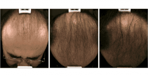 Hair-Regrowth-Boulder Microneedling