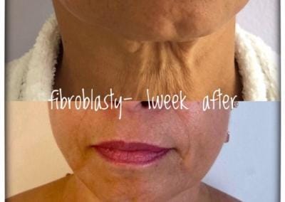 Fibroblasty before & after