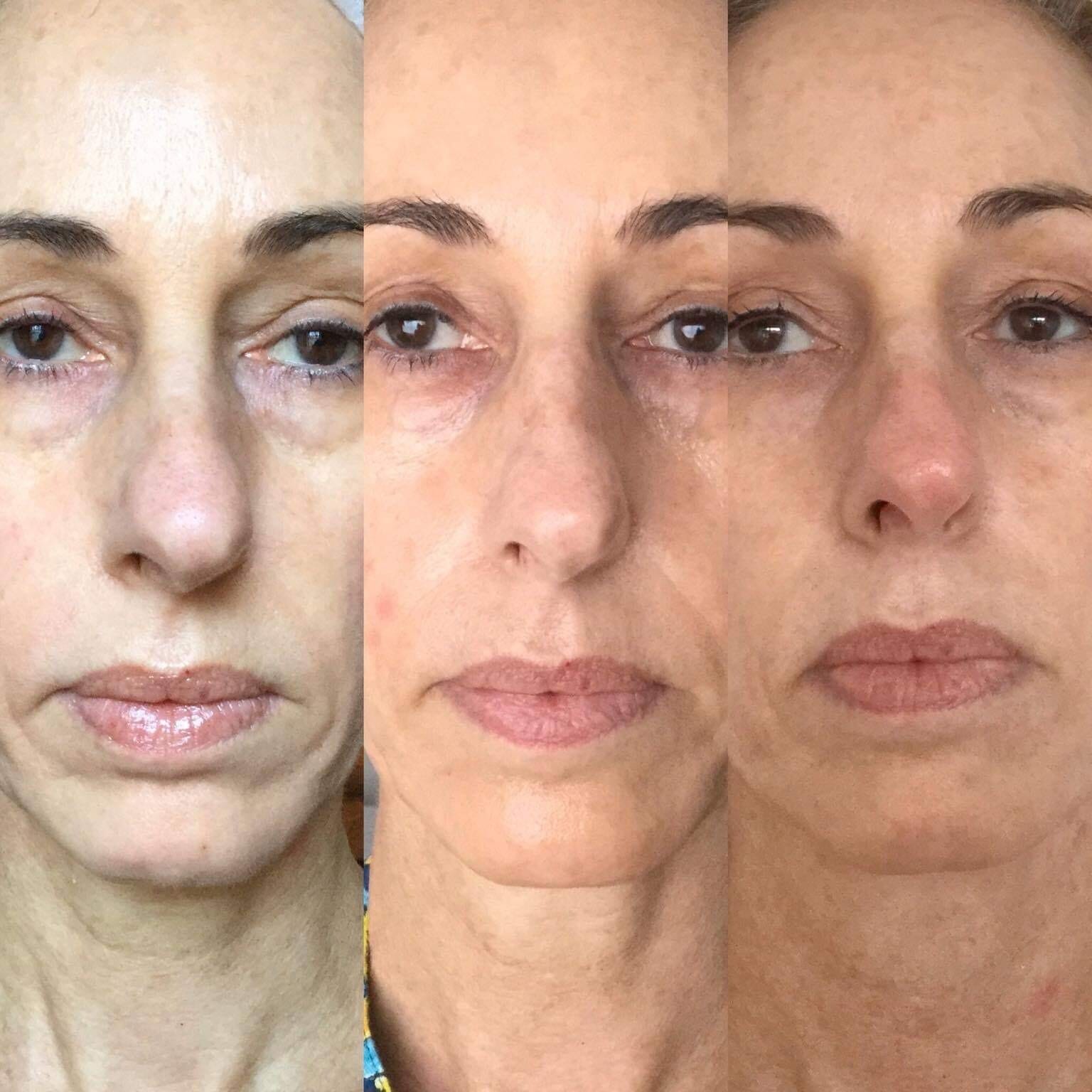 Fibroblasty nose sculpting before & after Fibroblasty nose sculpting before & after