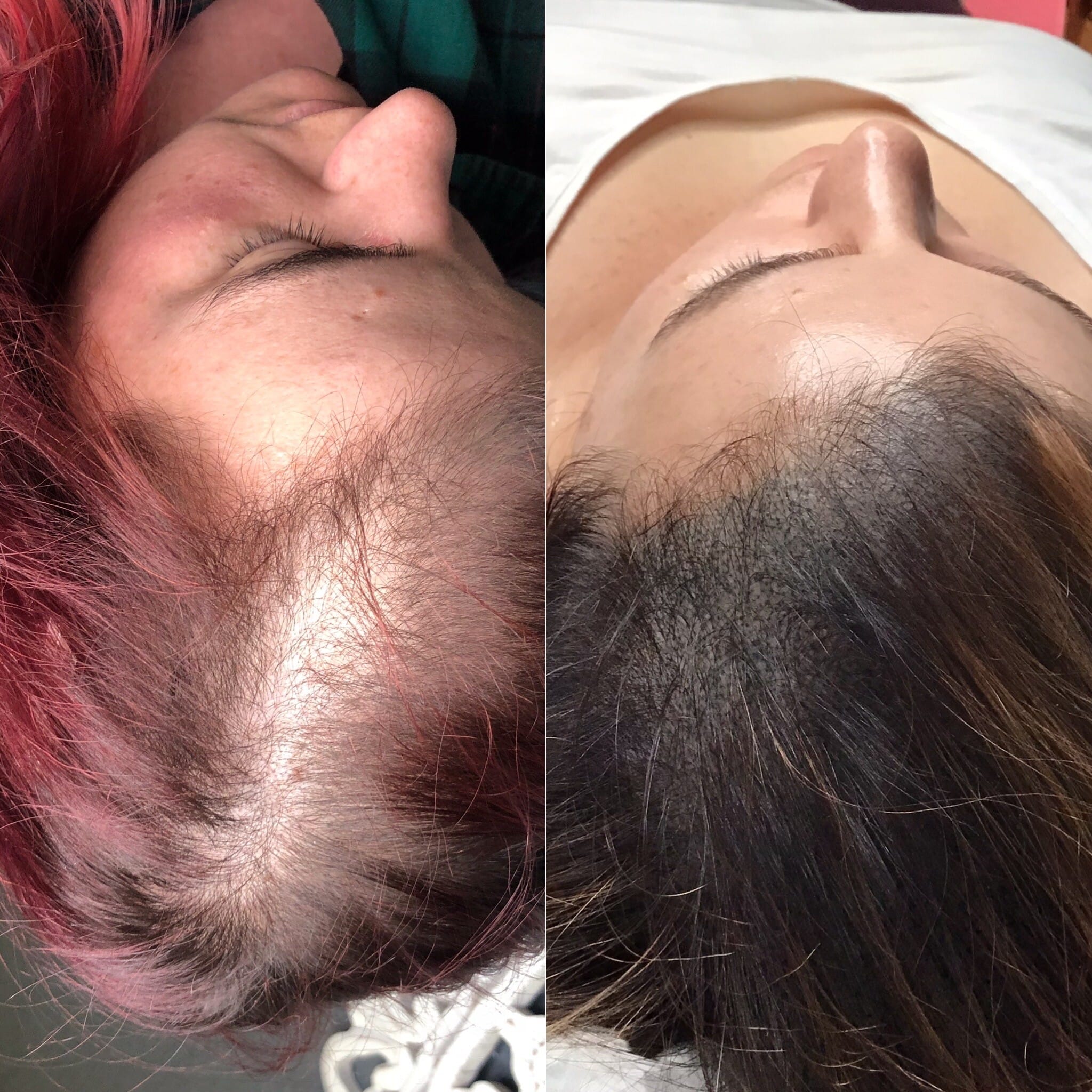 scalp-micro-testimonial-photo