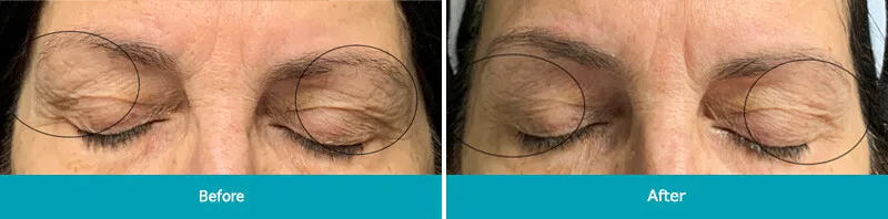 CO2 Lift Facial can safely and effectively correct a wide range of skin imperfections CO2 Lift Facial can safely and effectively correct a wide range of skin imperfections