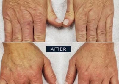 Zaffiro Before & After - Hands