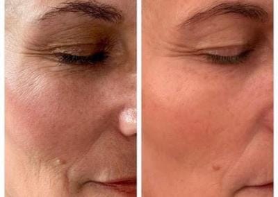 Zaffiro Before & After - Face