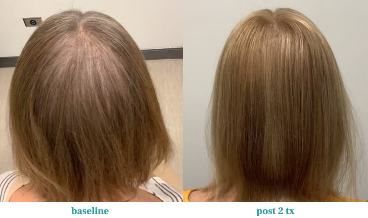 TED Hair Regrowth Treatment Colorado for Women
