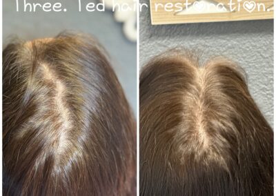 Ted-hair-restoration-11