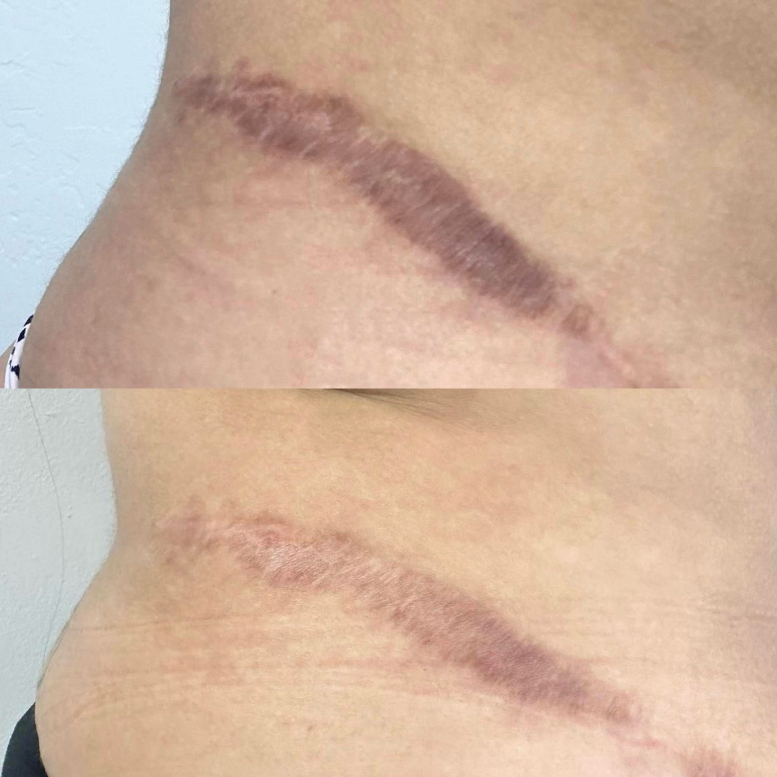 Before & After inkless stretch mark revision treatment