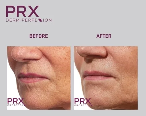 PRX-Derm-Perfexion-Treatment-1 Before & After PRX Derm Perfexion Treatment