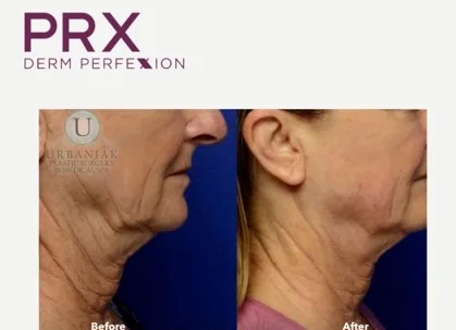 PRX-Derm-Perfexion-Treatment-22 PRX Derm Perfexion Treatment before & after
