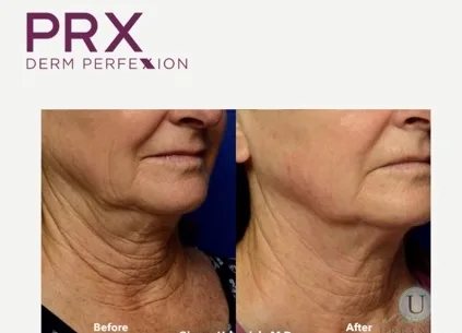 PRX-Derm-Perfexion-Treatment-23 PRX Derm Perfexion Treatment before & after