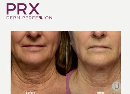 PRX-Derm-Perfexion-Treatment-25 PRX Derm Perfexion Treatment before & after
