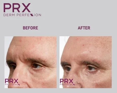 PRX-Derm-Perfexion-Treatment-26 PRX Derm Perfexion Treatment before & after