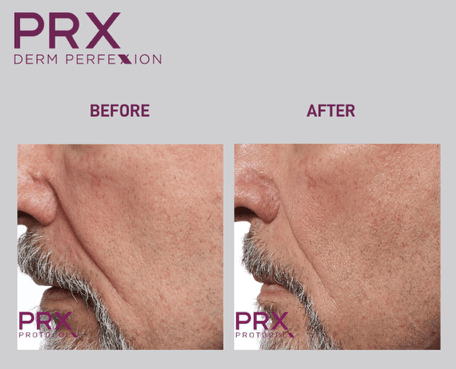 PRX-Derm-Perfexion-Treatment-27 PRX Derm Perfexion Treatment before & after