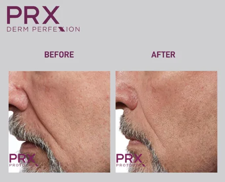 PRX-Derm-Perfexion-Treatment-27 PRX Derm Perfexion Treatment before & after