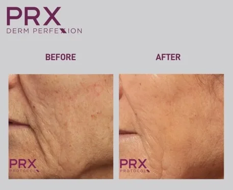 PRX-Derm-Perfexion-Treatment-28 PRX Derm Perfexion Treatment before & after