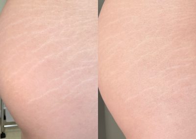 Inkless Stretch Mark Revision in Boulder