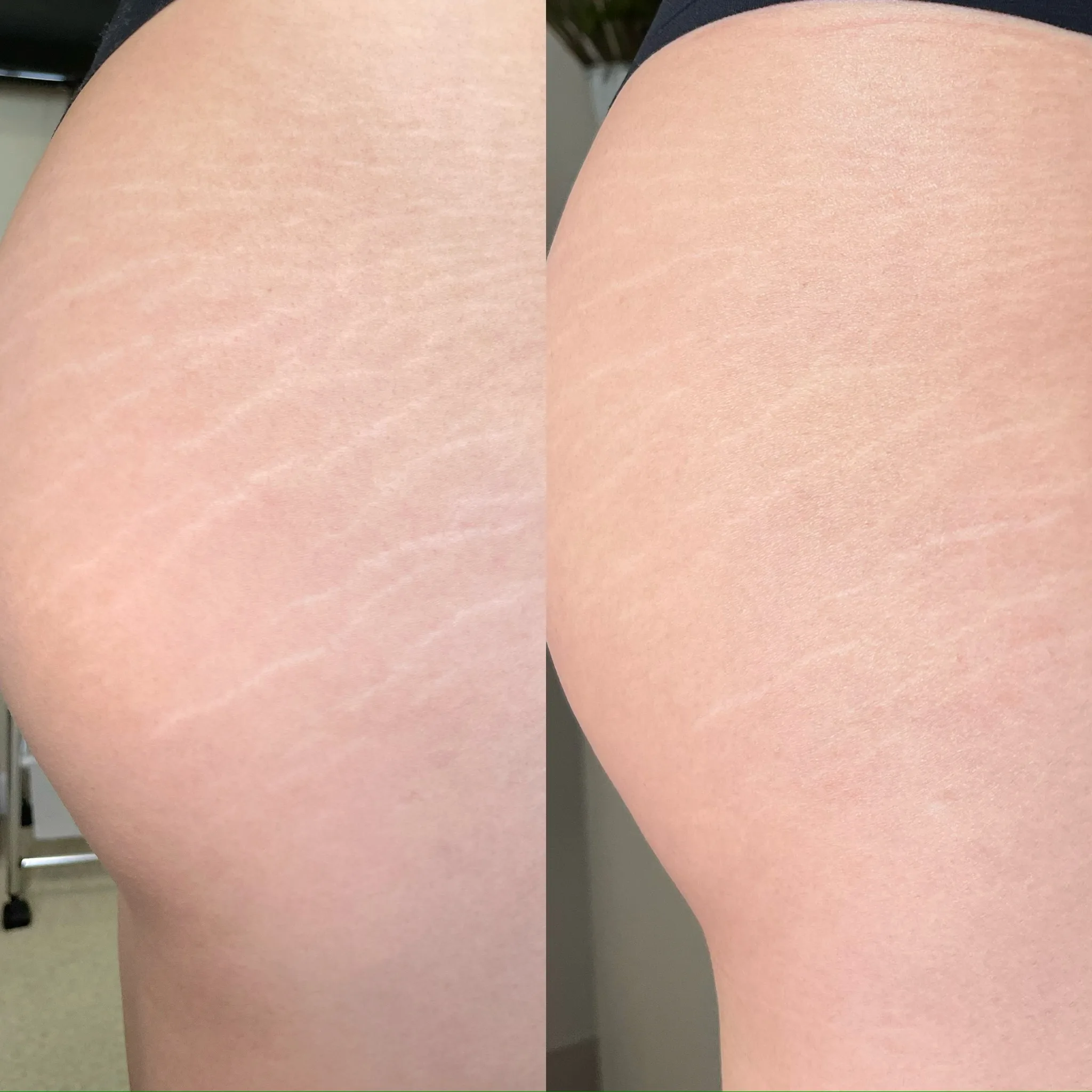 Inkless Stretch Mark Revision in Boulder Inkless Stretch Mark Revision in Boulder