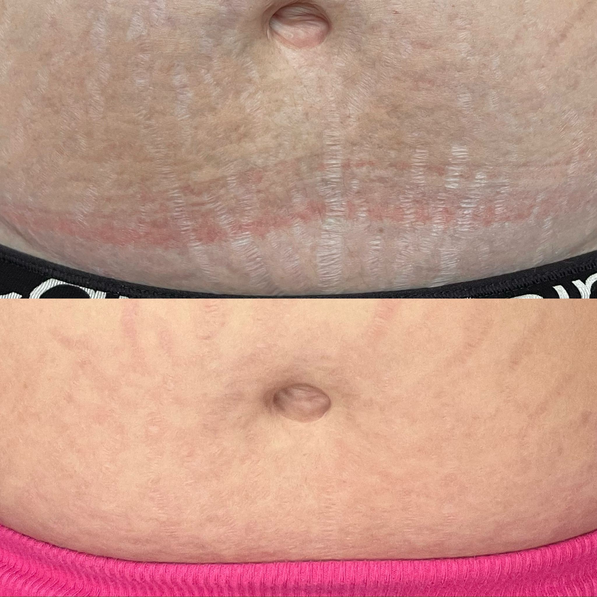 Before & After inkless stretch mark revision treatment