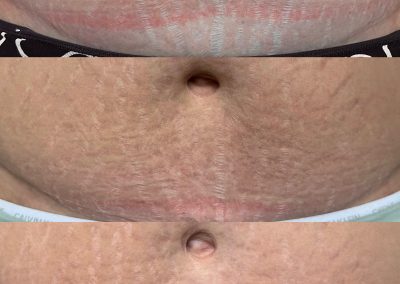 Before & After inkless stretch mark revision treatment