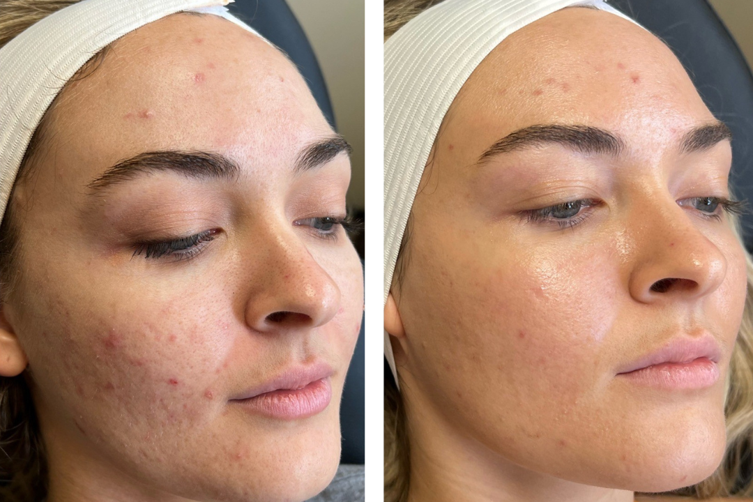 Experience the revolutionary CoolPeel® laser treatment – our latest innovation in skincare technology