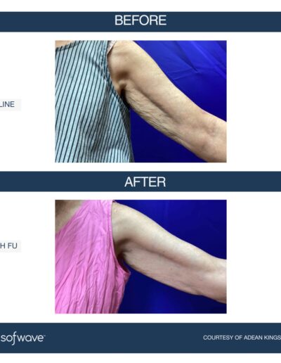 Sofwave - improve skin laxity, lift, and tone in your arms - before and after image - Boulder Colorado