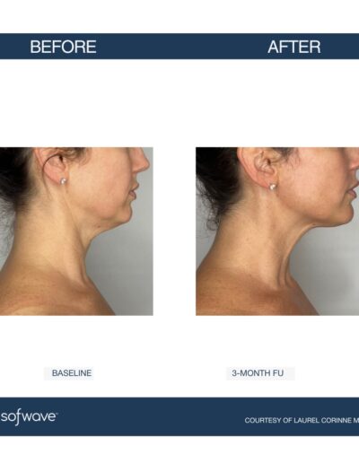 Sofwave - improve skin laxity, lift, and tone in your neck - before and after image - Boulder Colorado