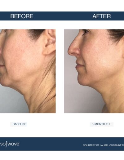 Sofwave - improve skin laxity, lift, and tone - Boulder Colorado