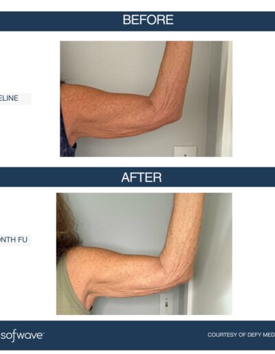 Sofwave - improve skin laxity, lift, and tone - treats all skin types - before and after image - Boulder Colorado