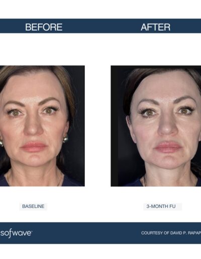 Sofwave - improve skin laxity, lift, and tone - improve fine lines and wrinkles - before and after image - Boulder Colorado