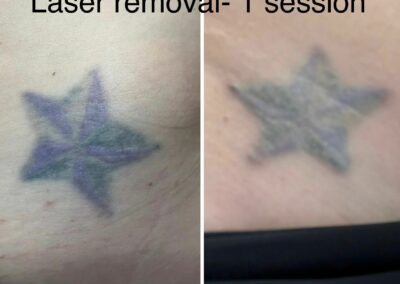 Laser Tattoo and Permanent Makeup Removal in Boulder Colorado