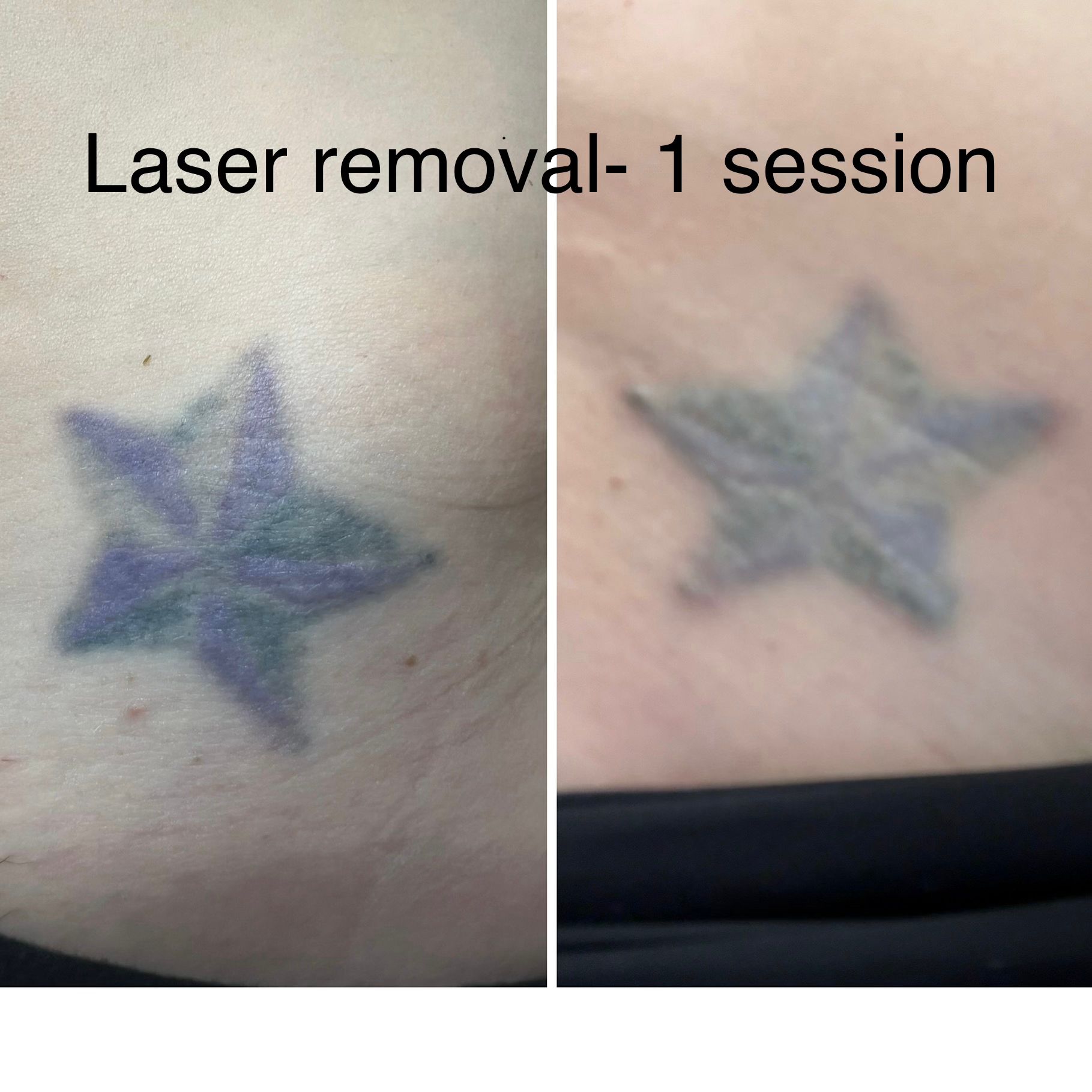 Laser Tattoo and Permanent Makeup Removal in Boulder Colorado