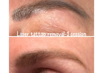 Laser Tattoo and Permanent Makeup Removal in Boulder Colorado