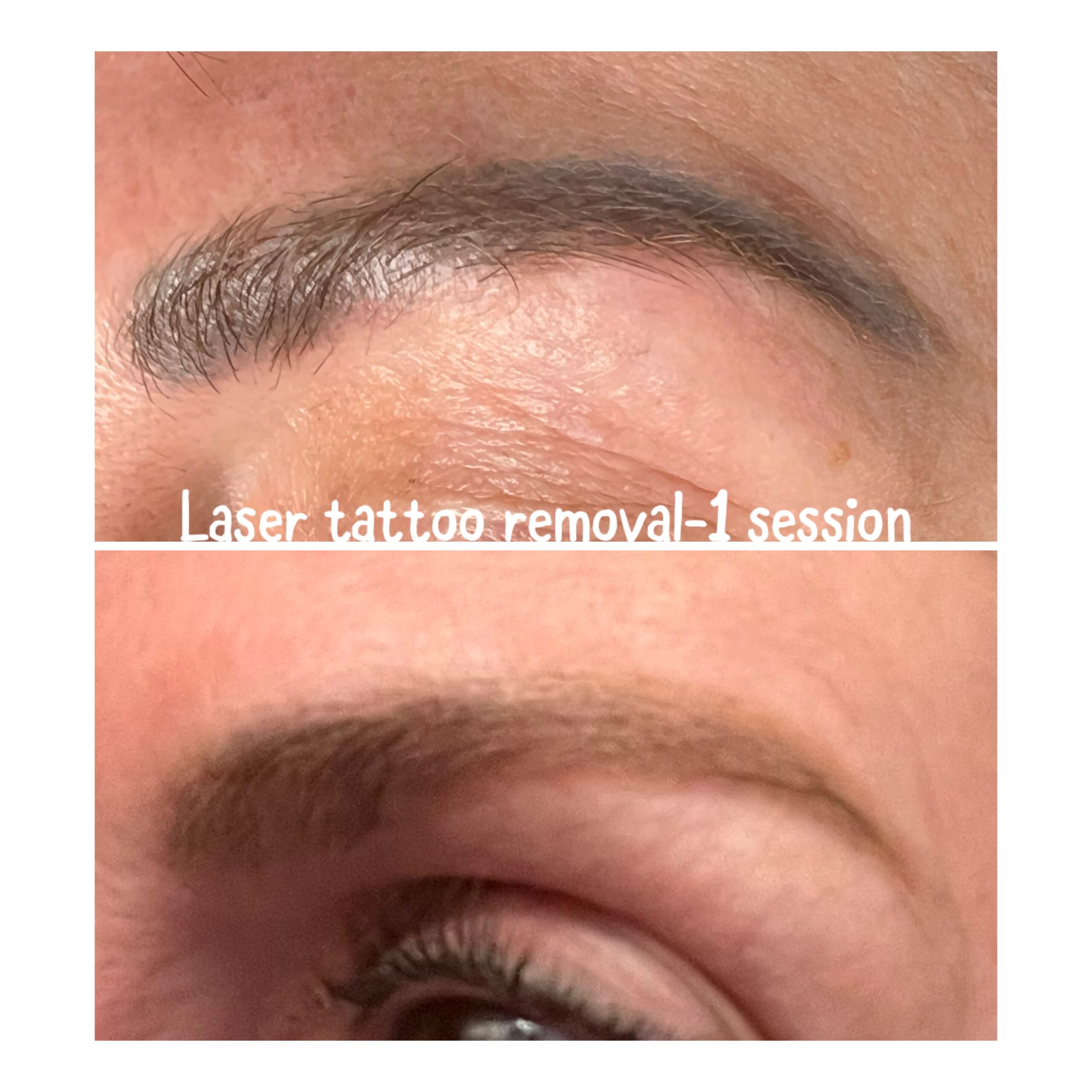 Laser Tattoo and Permanent Makeup Removal in Boulder Colorado