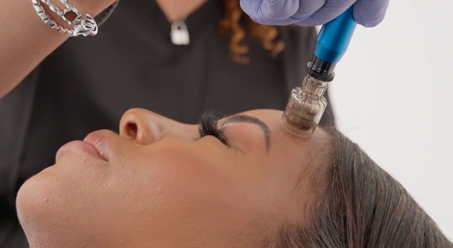 Microneedling in Boulder Colorado - Collagen Induction Therapy for Healthier, Younger-Looking Skin