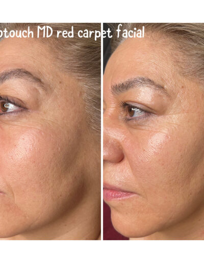 Red Carpet Facial - Boulder Colorado