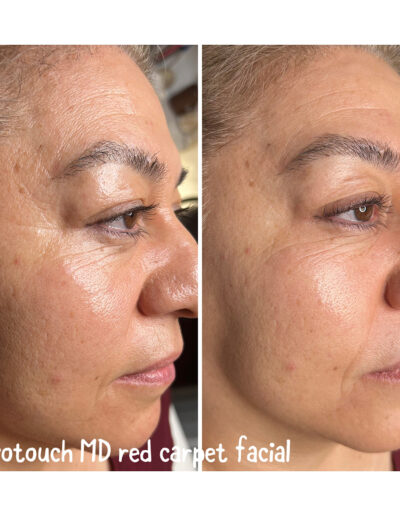Red Carpet Facial - Boulder Colorado