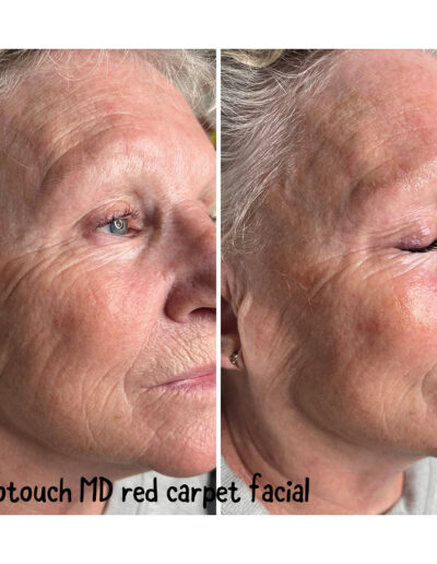 Red Carpet Facial - Boulder Colorado