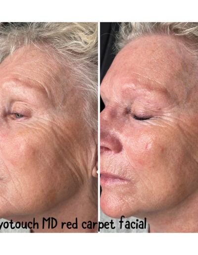 Red Carpet Facial - Boulder Colorado