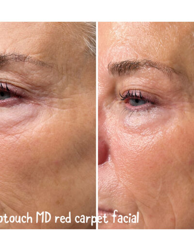 Red Carpet Facial - Boulder Colorado