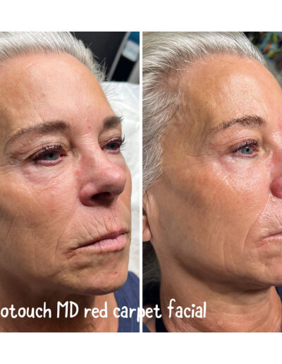 Red Carpet Facial - Boulder Colorado